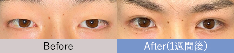 湘南美容クリニック　二重整形　症例
