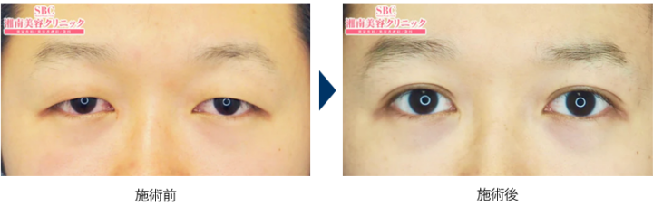 湘南美容クリニック　二重整形　症例