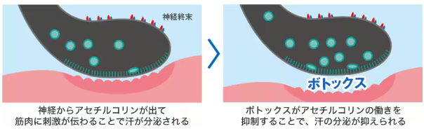 湘南美容クリニック 脇汗ボトックス