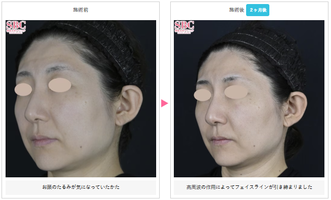 湘南美容クリニック デンシティ症例