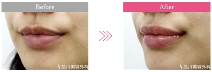 品川美容外科　唇ヒアルロン酸