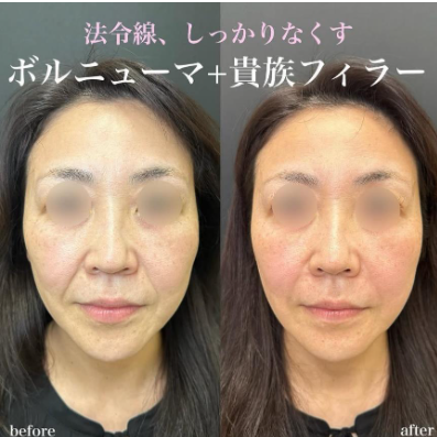 ルラ美容クリニック　ボルニューマ症例