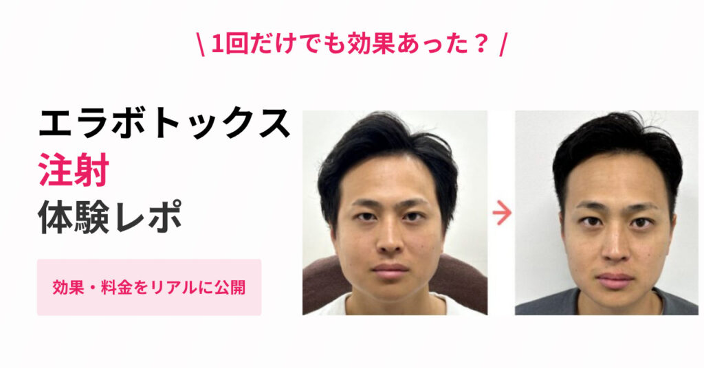 【実体験】エラボトックス注射は一回だけでも効果がありました