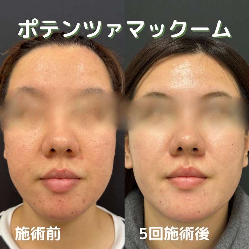 ルラ美容クリニック　ポテンツァ症例画像