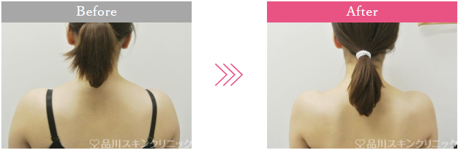 品川美容外科　肩ボトックス症例