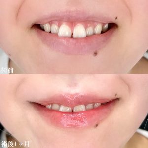 TCB東京中央美容外科　ガミースマイル　症例
