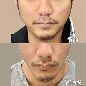 TCB東京中央美容外科　糸リフト