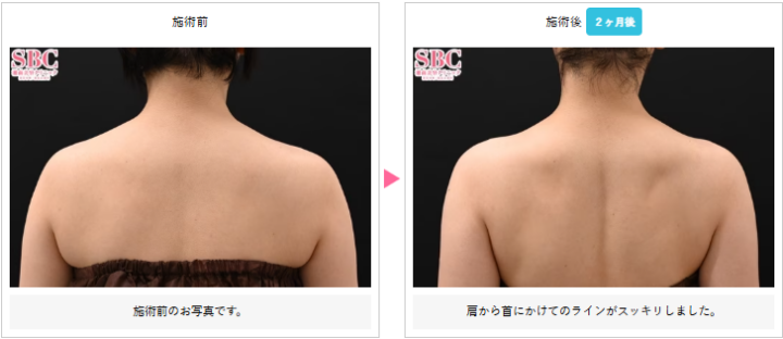 湘南美容クリニック 肩ボトックス症例