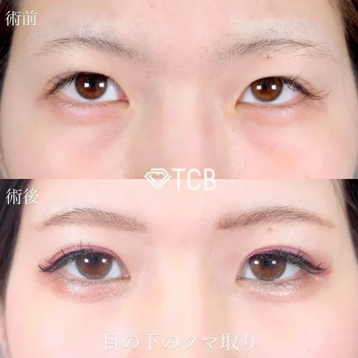 TCB東京中央美容外科　目の下のクマ取り
