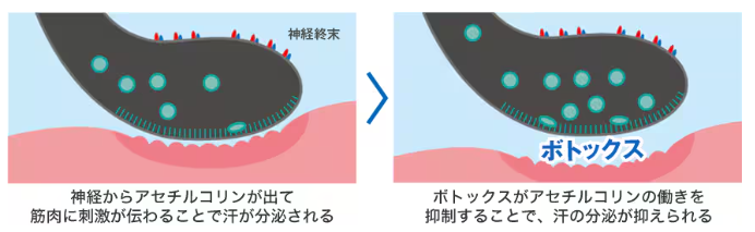 湘南美容クリニック　脇ボトックス