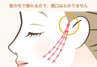 糸リフト