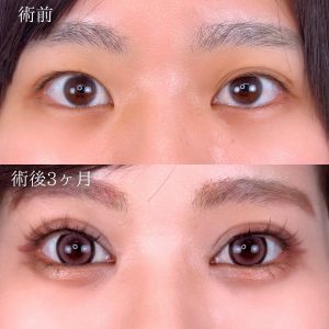 TCB東京中央美容外科　二重整形