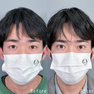 TCB東京中央美容外科 二重整形
