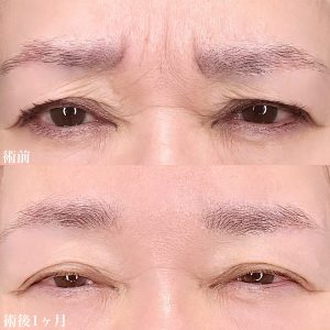 TCB東京中央美容外科　眉間のしわ治療