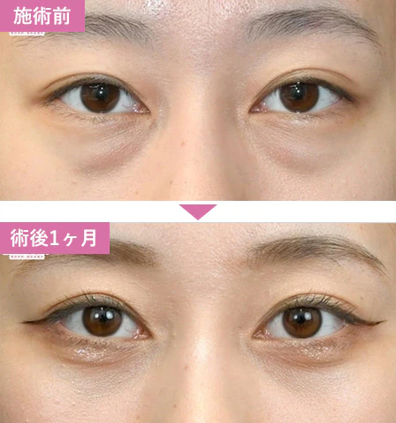 湘南美容クリニック 目の下のクマ取り