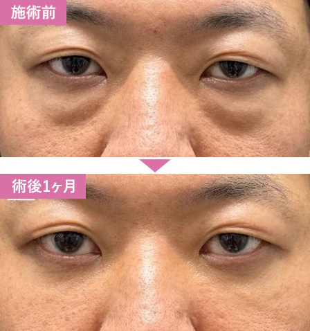 湘南美容クリニック 目の下のクマ取り