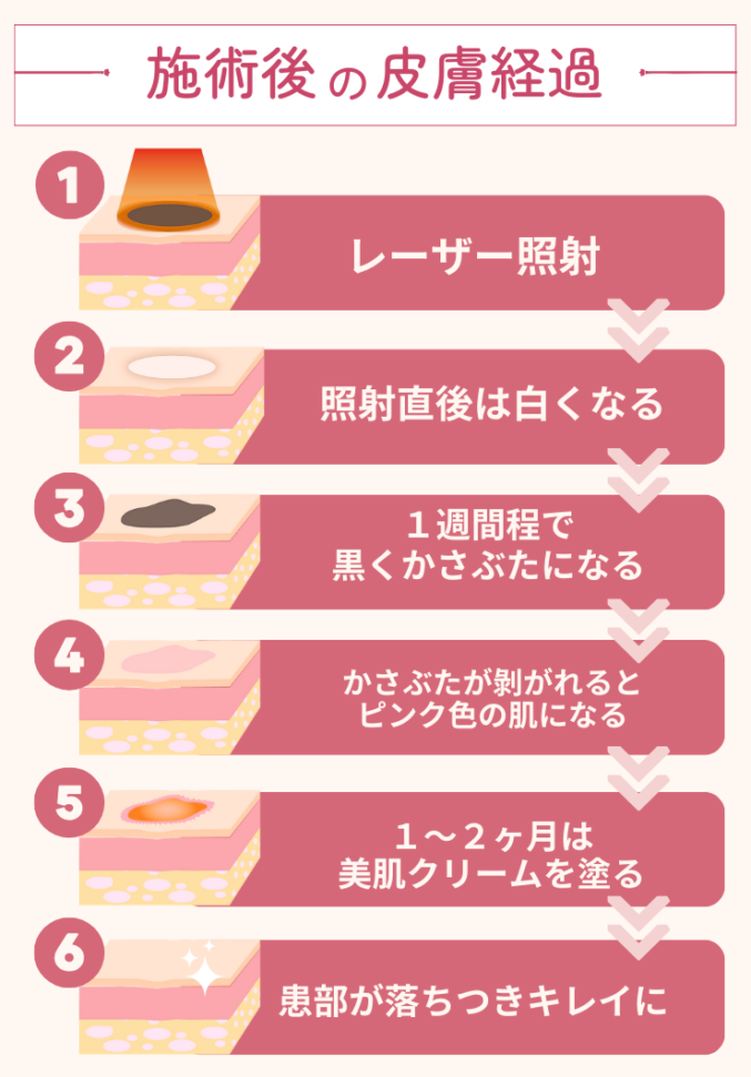 シミ取りの仕組み