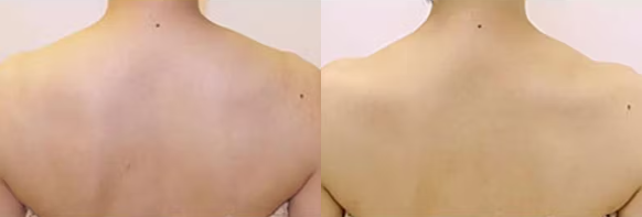 品川美容外科　肩ボトックス