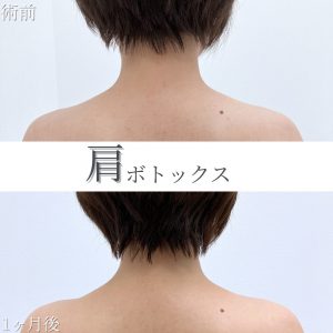 TCB東京中央美容外科　肩ボトックス