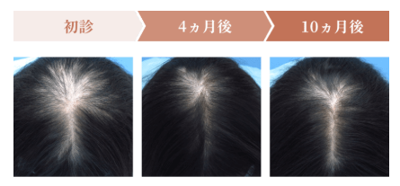 クレアージュ 発毛治療症例画像