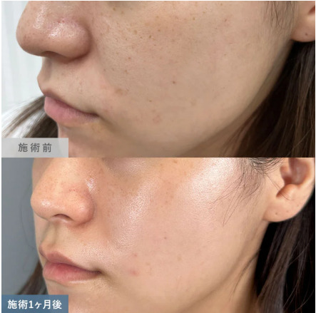 TCB ピコレーザー症例