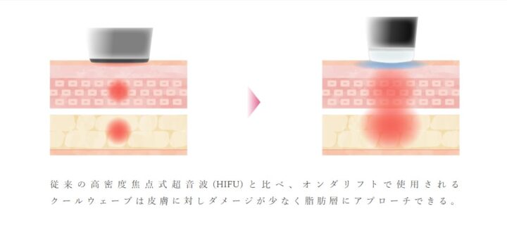 オンダリフト　ハイフとの違い