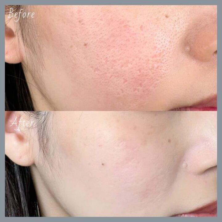 TCB　ニキビ跡治療　症例画像