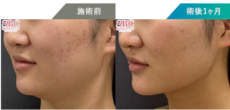 湘南美容クリニック オンダリフト症例