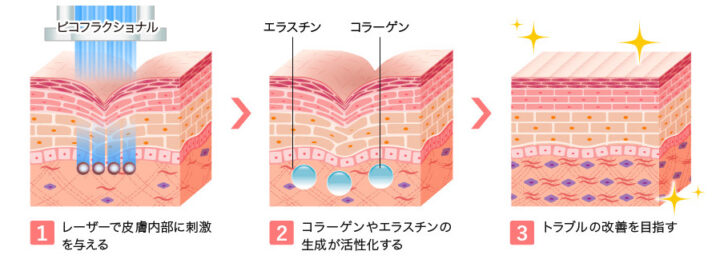 TCB　ピコフラクショナル詳細画像