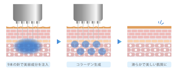 水光注射