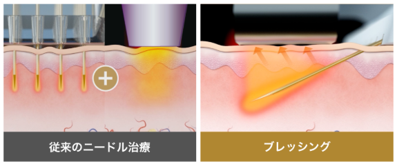 NEXUS CLINIC ブレッシング