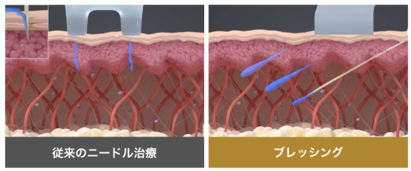 NEXUS CLINIC ブレッシング