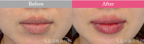 品川美容外科　レッド・グロス注射症例