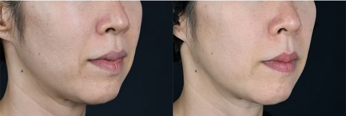 湘南美容クリニック　XERF（ザーフ）症例