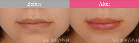 品川美容外科　レッド・グロス注射症例