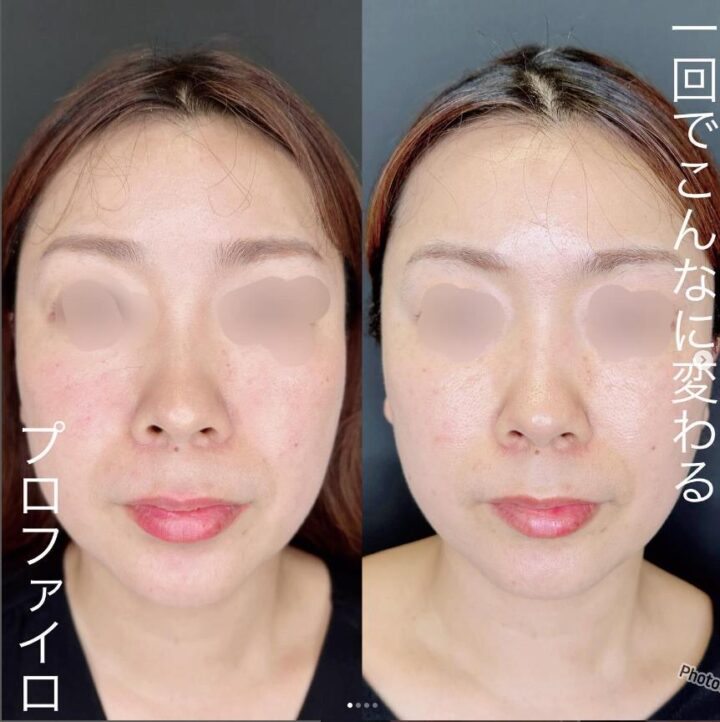 ルラ美容クリニック　プロファイロ　症例画像