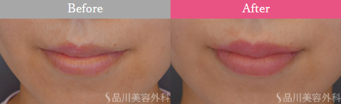 品川美容外科　レッド・グロス注射症例