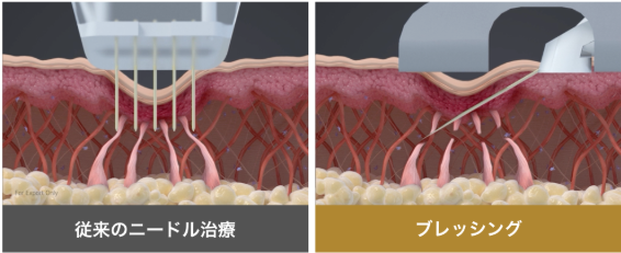 NEXUS CLINIC ブレッシング