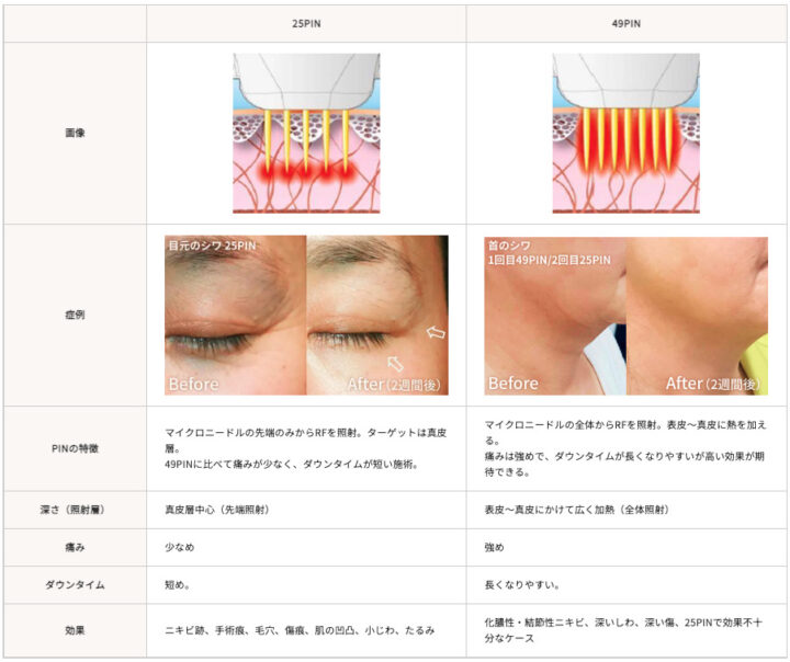 TAチップの種類