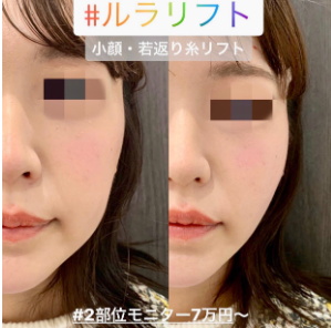 ルラ美容クリニック　ルナリフト症例