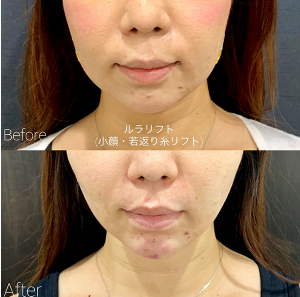 ルラ美容クリニック　ルナリフト症例