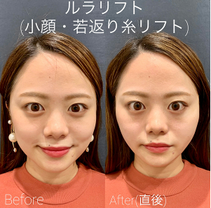 ルラ美容クリニック　ルナリフト症例