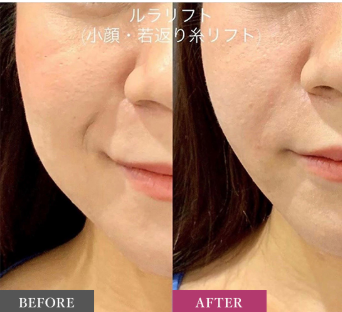ルラ美容クリニック　ルナリフト症例