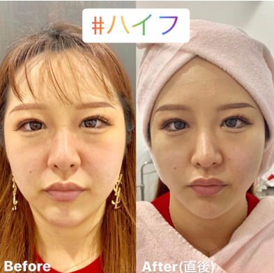 ルラ美容クリニック　ハイフ症例