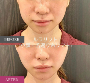 ルラ美容クリニック　ルナリフト症例
