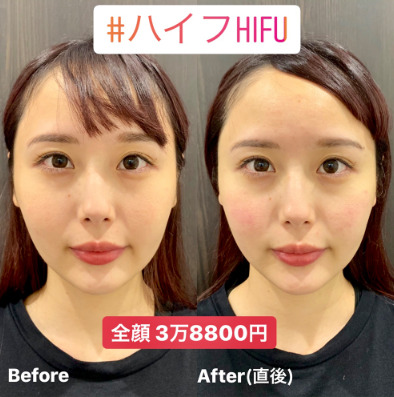 ルラ美容クリニック　ハイフ症例