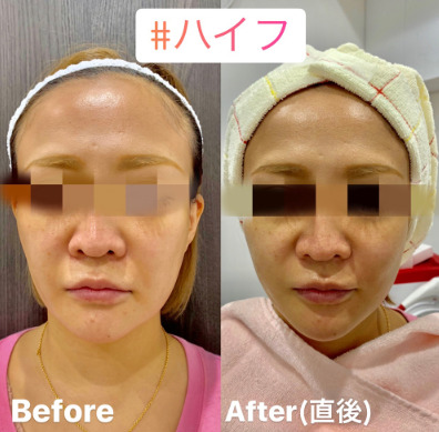 ルラ美容クリニック　ハイフ症例