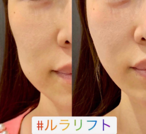 ルラ美容クリニック　ルナリフト症例
