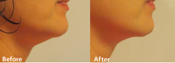 ルラ美容クリニック　ハイフ症例