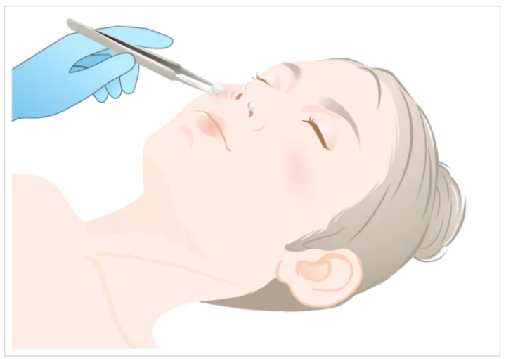 TCB 花粉症ボトックス